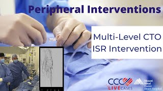 MultiLevel CTO ISR Intervention [upl. by Halladba]