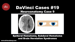 Epidural vs Subdural Hematoma and Brain Herniation Syndromes Case DaVinciCases Neuroanatomy 9 [upl. by Aisatana175]