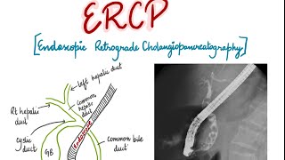 ERCP Endoscopic Retrograde Cholangiopancreatography presentation for medical students [upl. by Accever]