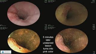 Early Detection of Esophageal Cancer and Barrett’s Esophagus Recent Advances [upl. by Abbye]