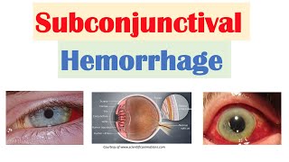 Subconjunctival Hemorrhage Blood in Eye  Causes Signs amp Symptoms Diagnosis Treatment [upl. by Allesiram514]