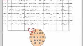 EEG  101 [upl. by Illek]