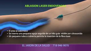 Animation of Ablación Laser Endovenosa [upl. by Sirob]