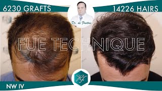 Injerto Capilar Técnica FUE – 6230 Grafts 14226 Pelos – Dr Rafael de Freitas [upl. by Backler]