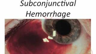 subconjunctival hemorrhage [upl. by Orran]