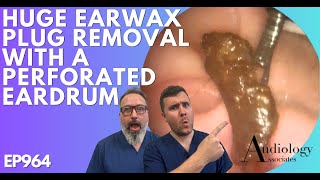 HUGE EAR WAX PLUG REMOVAL WITH A PERFORATED EARDRUM  EP964 [upl. by Nyladgam]