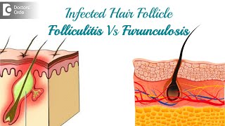 Infected hair follicle What to do Causes Location amp TreatmentDr Rasya Dixit  Doctors Circle [upl. by Linis]