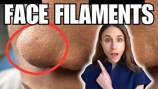 Sebaceous Filaments Vs Demodex Face Mites [upl. by Warrick631]