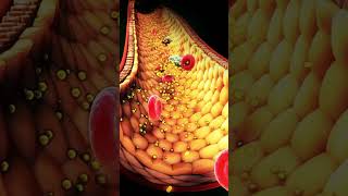 Treating Heart Disease  Part 2  Arteriosclerosis [upl. by Yauqram12]