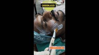 Carbon laser treatmentShubiksha hairampskin care clinicprpgfcbalajinagarkatturtrichy9150923153 [upl. by Auroora297]