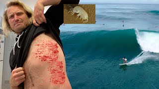 I Got SEA LICE all Over  Gnarly Rash [upl. by Marcy]