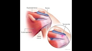 Tendonitis or Tendinitis  Definition causes Symptoms Diagnosis Treatment [upl. by Ayela]