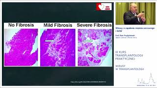 Prof Piotr Przybyłowski – Wirusy a zapalenia mięśnia sercowego i OZW [upl. by Colfin766]