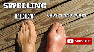 Foot and Ankle Swelling What are Causes and cures [upl. by Dael]