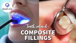 Composite Fillings  Composite filling procedure  Composite bonding to the tooth [upl. by Gautier]