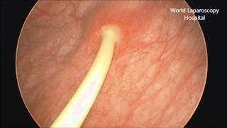 Removal of Double J stent by Cystoscopy [upl. by Schuyler712]