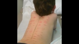 Food Allergy Testing [upl. by Tray]