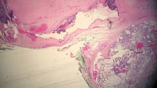 Polymorphous Low Grade Adenosarcoma of the Minor Salivary Gland [upl. by Ettebab]