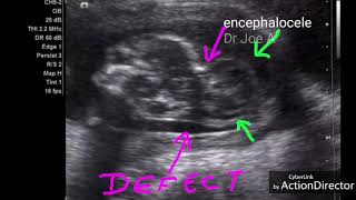 Occipital encephalocele ultrasound video [upl. by Ayekehs]