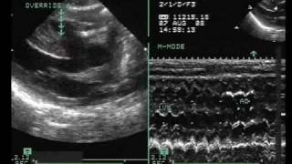 Tetralogy of Fallot with Vertically Oriented PDA [upl. by Neelear553]