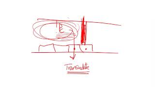 286 Acute Inflammation  Macrophages rule amp Exudate vs Transudate [upl. by Lydnek159]