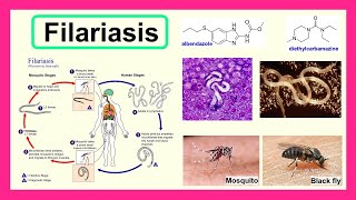 filariasis [upl. by Adnohsat]