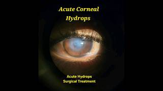 Acute Corneal Hydrops Surgical Draining [upl. by Nnylekoorb392]