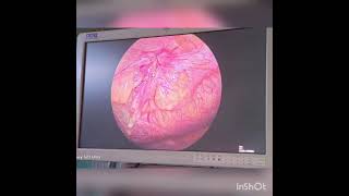 Laparoscopic Umbilical hernia repairIPOM PLUS [upl. by Ivan]