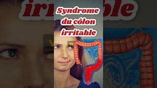 Causes côlon irritable Syndrome intestin Nerveux colopathie Fonctionnelle colonirritable colon [upl. by Alyahs]