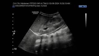 Medullary Nephrocalcinosis [upl. by Eremihc]