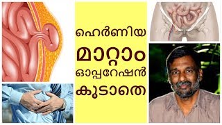 Treatment for Hernia without operation  Mohanan Vaidyar [upl. by Feune]