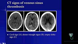 Imaging Features Of Venous Sinus Thrombosis Part 2 Health4TheWorld Academy [upl. by John411]