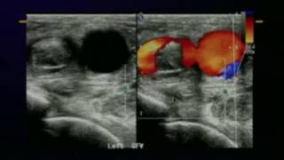 Lower Extremity Venous Protocols and Interpretation [upl. by Annairol]