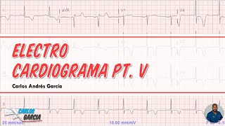 EKG Pt V  Crecimiento Auricular Derecha e Izquierda Ondas P Picudas y Melladas [upl. by Fitalludba327]