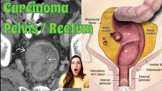 Carcinoma Rectum • Urinary bladder • Pelvis  CECT PELVIS [upl. by Ailhat395]