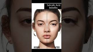 Hello Salicylic acid bye bye Acne skincare acnespottreatment acne salicylicacid healthyskin [upl. by Benioff271]