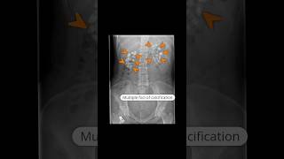 Medullary nephrocalcinosis due to type 1 renal tubular acidosis virlshorts [upl. by Eseer]