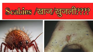 स्केबीज खाज  खुजली scabies scabies scabiestreatment [upl. by Efal]