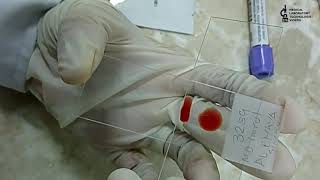 Blood smear preparation2 methods to learnThick amp Thin smear preparation [upl. by Ainoz127]