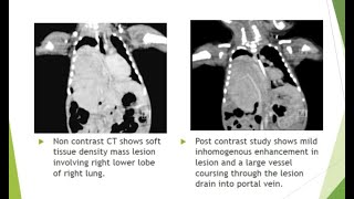 CASE OF THE WEEK  BRONCHOPULMONARY SEQUESTRATION [upl. by Whit57]