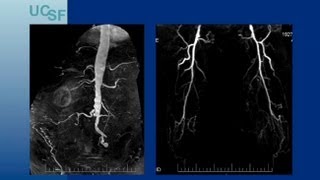 Endovascular Approaches for TASC CD Aortoiliac Lesions  UCSF Vascular Surgery Symposium 2013 [upl. by Annis]