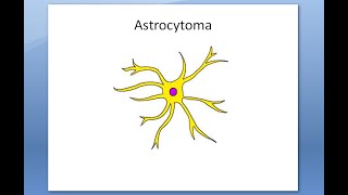 Pathology 895 a Astrocytoma Glioma Grade Pilocytic glioblastoma multiforme microscopy histology [upl. by Holly58]