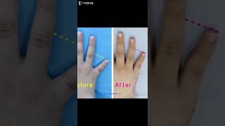 brachydactyly 短指症手術 短指症 단지증 단지증수술 단지증수술후기 braquidactilia عضدي الأصابع брахидактилия [upl. by Kahcztiy]