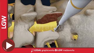 L5S1 Lumbar Discectomy and Fusion Surgery 3D animation [upl. by Latonia]