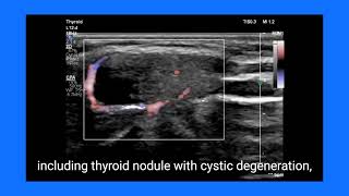 Identifying a Thyroglossal Duct Cyst on Ultrasound Key Findings and Differential Diagnosis [upl. by Ahsyek595]