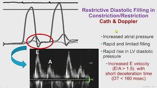 Constrictive Pericarditis [upl. by Ellenuahs706]