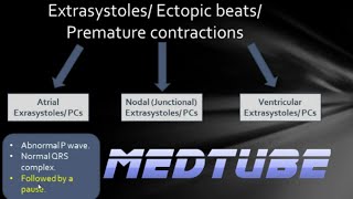 ECGs abnormal rhythms Extrasystoles [upl. by Yekcir]