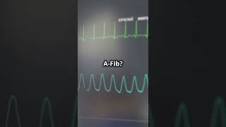 NEVER Miss These AFiB Signs on an ECG [upl. by Viguerie]