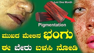 How to Remove Pigmentation Melasma Naturally Kannada  Skin Pigmentation Tips  Bhangu in Kannada [upl. by Eudocia]