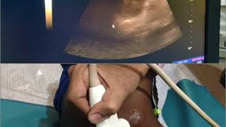 Ultrasound Chest How to doTips ampTricks Pleural Effusion Protocol Mistakes  Tubercular [upl. by Eatton]